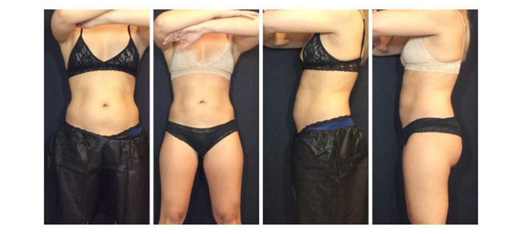 Abdomen before and after results from CoolSculpting treatment at Metro Laser in Philadelphia, PA.