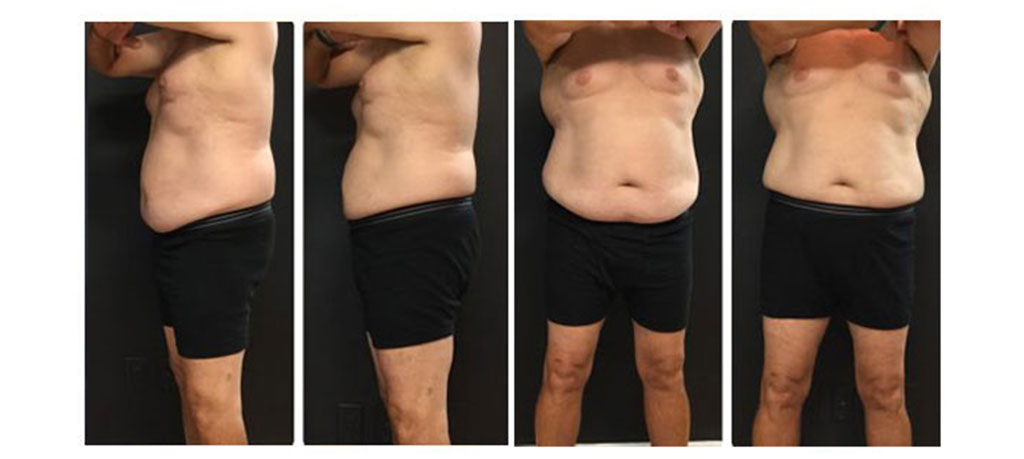 Abdominal region before and after results from CoolSculpting treatment at Metro Laser in Philadelphia, PA.