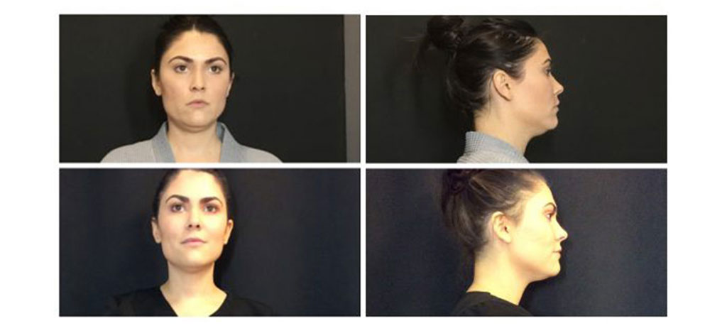 Under chin before and after results from CoolSculpting treatment at Metro Laser in Philadelphia, PA.