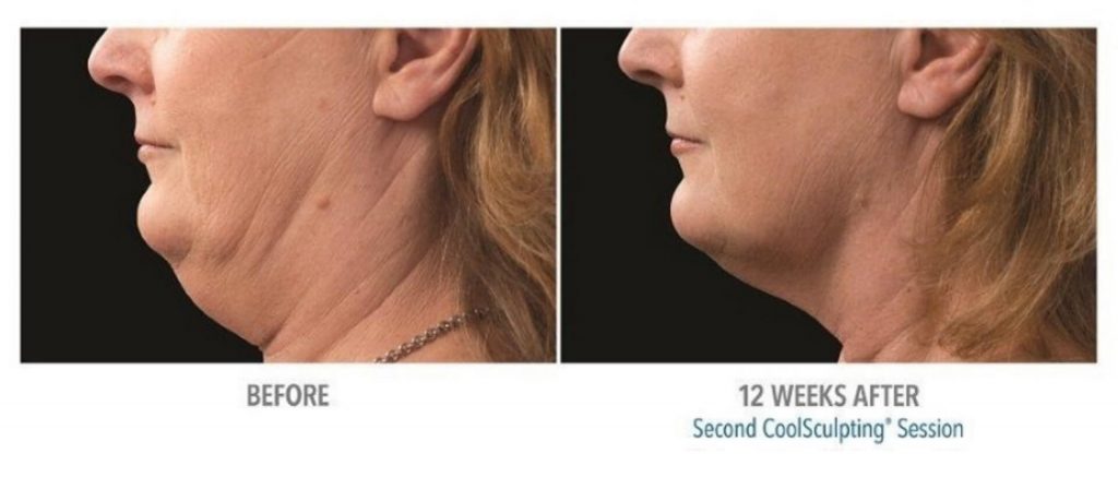 Under chin before and after results from CoolSculpting treatment at Metro Laser in Philadelphia, PA.