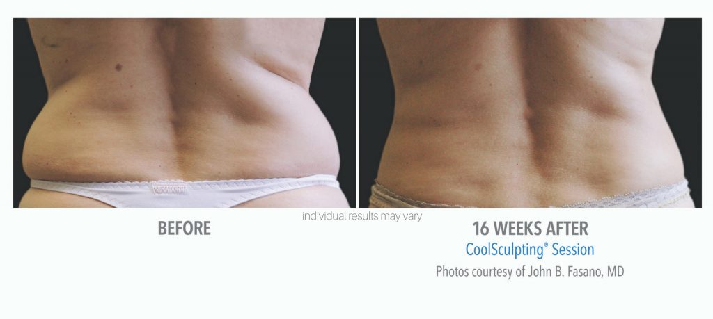 Love handles before and after results from CoolSculpting treatment at Metro Laser in Philadelphia, PA.