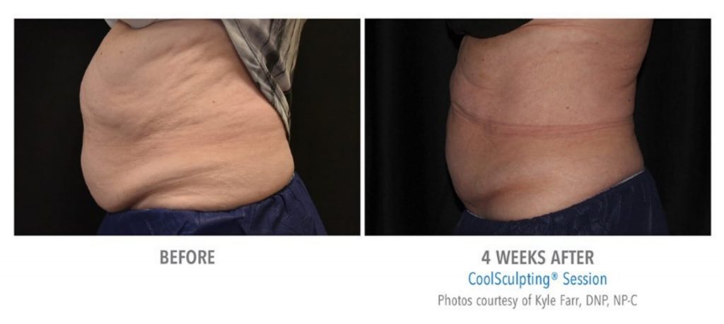 Abdomen before and after results from CoolSculpting treatment at Metro Laser in Philadelphia, PA.
