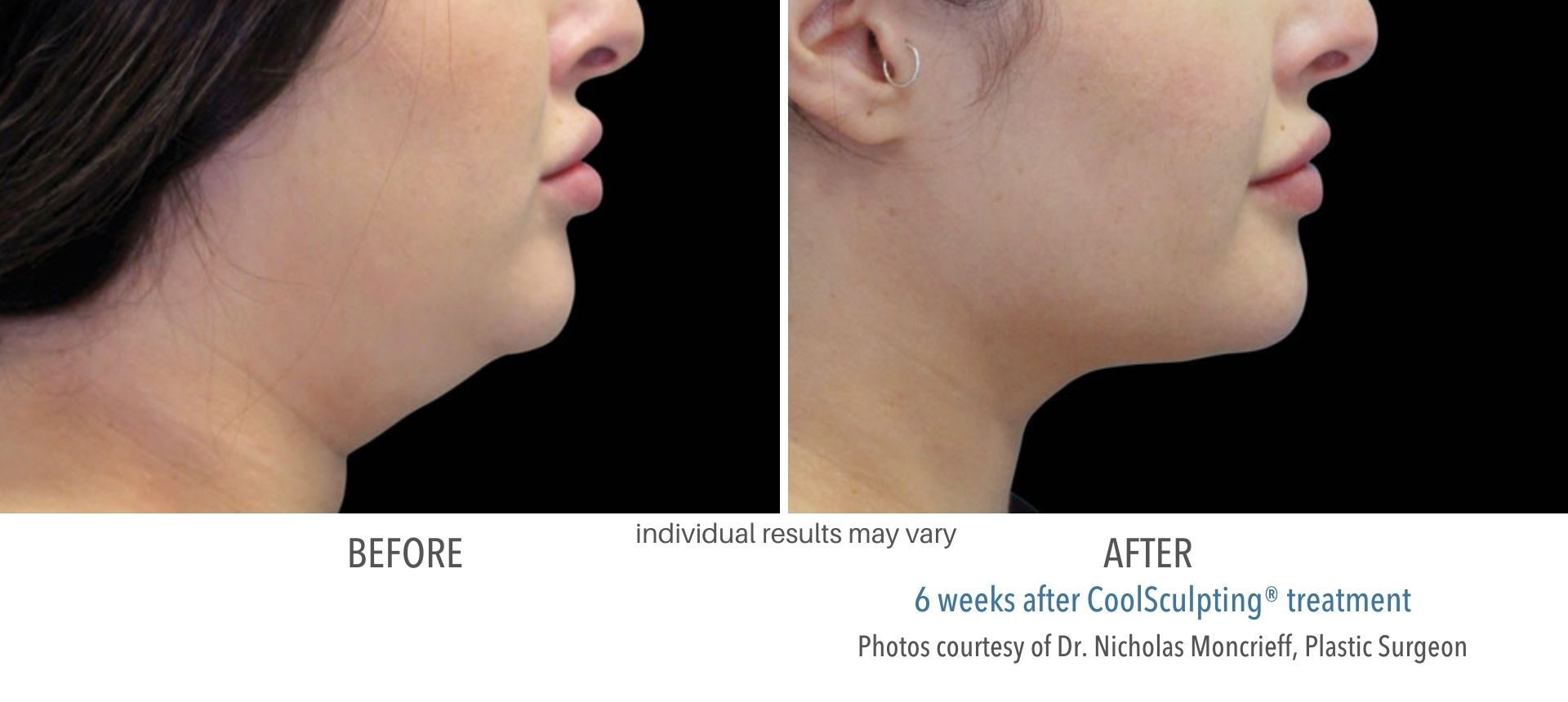 coolsculpting treatment for double chin