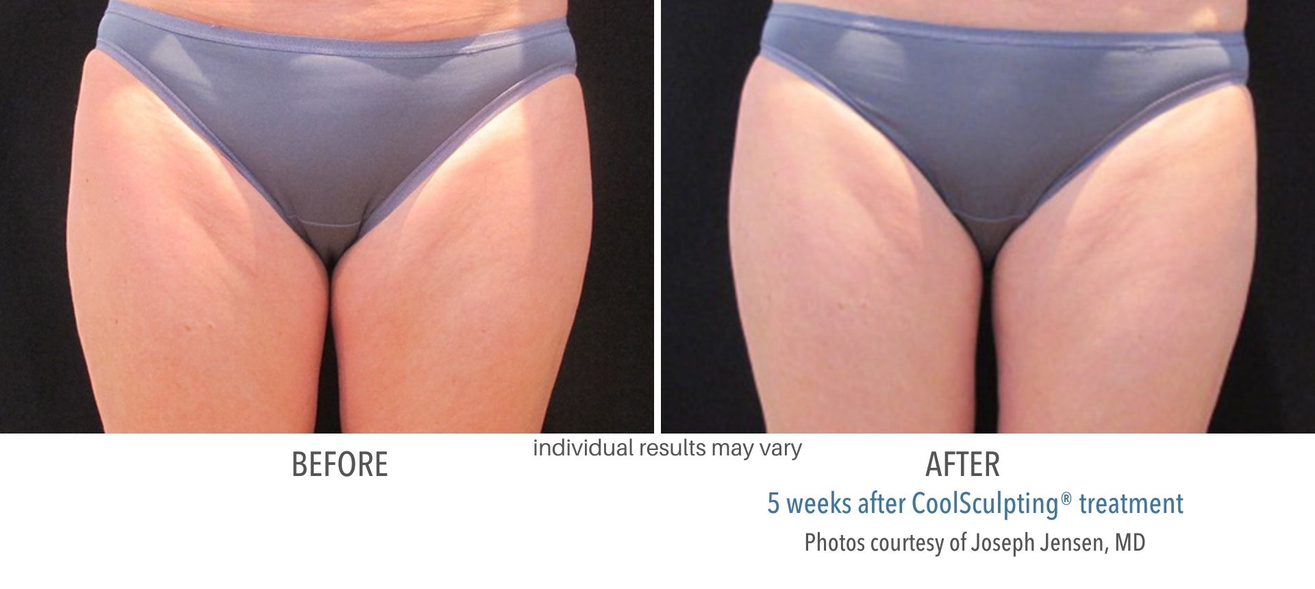 coolsculpting inner thighs