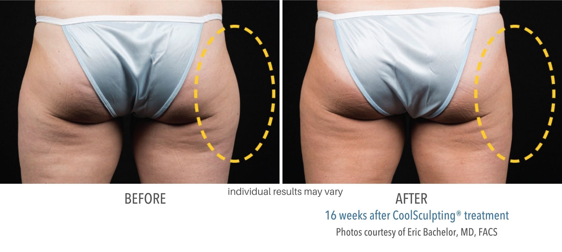 coolsculpting outer thighs