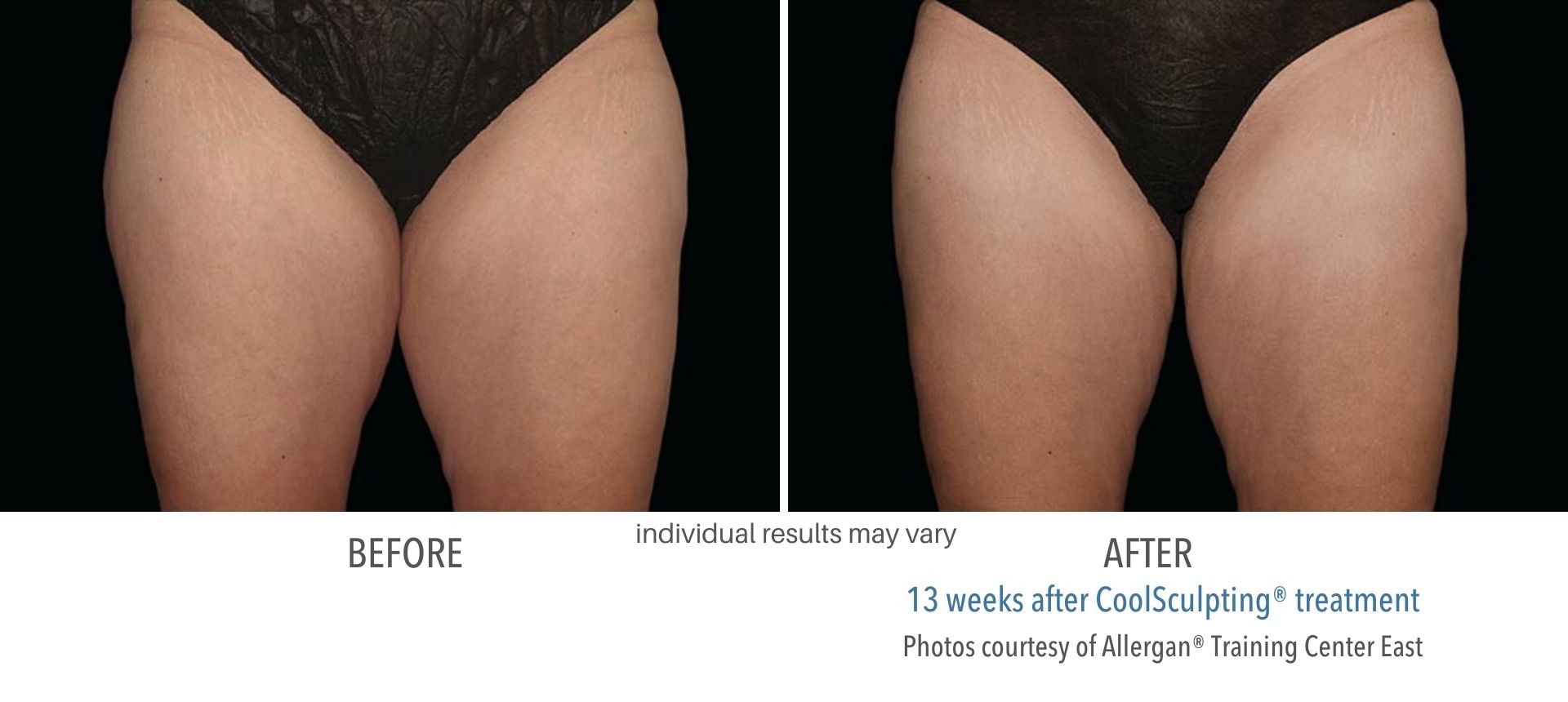 coolsculpting inner thighs treatment