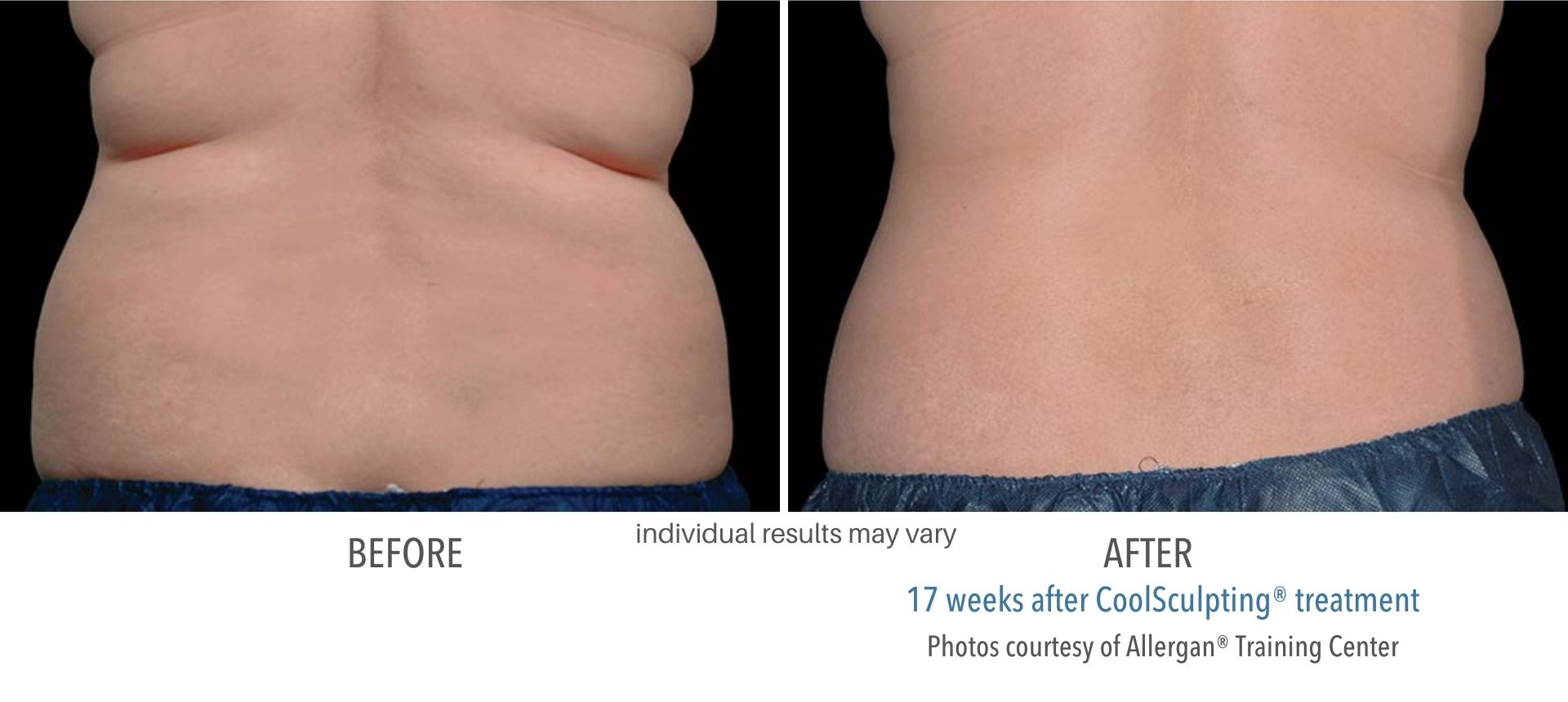 CoolSculpting before and after images of actual patients
