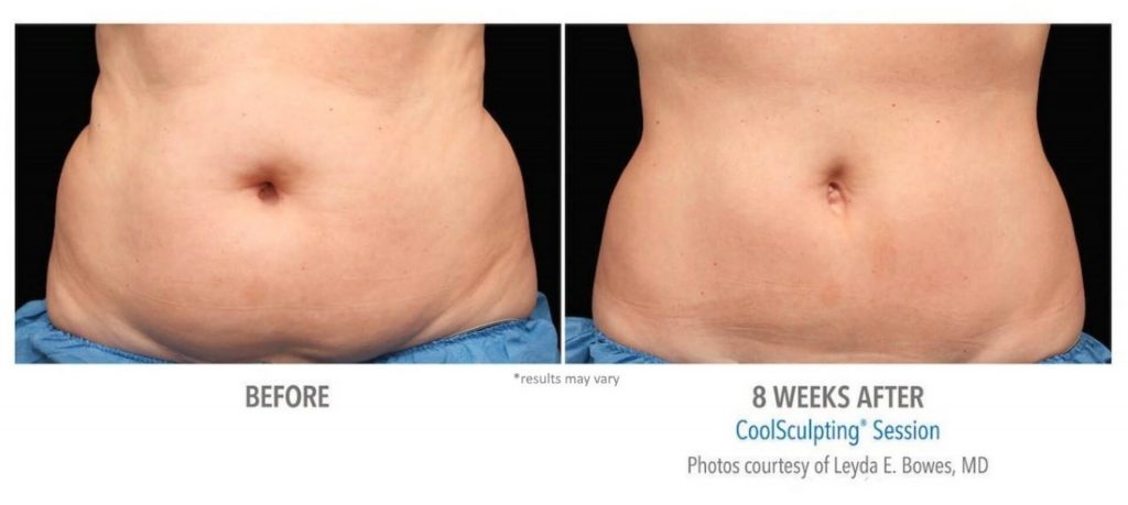 coolsculpting_-before-and-after-metrolaser
