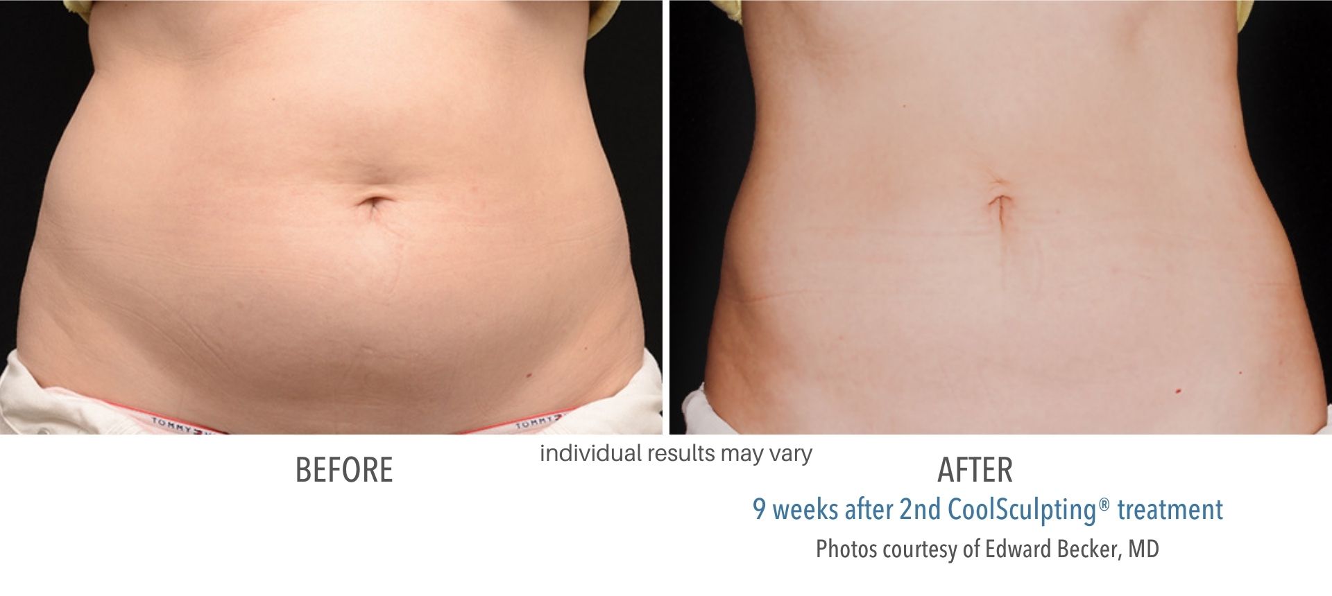 coolsculpting_before_and_after_images_metrolaserphilly_13